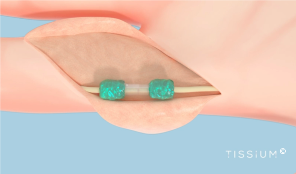 tissue reconstruction